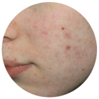 acne after ipl