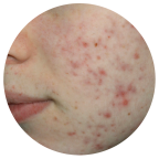 acne before ipl