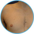 chest after ipl hair removal